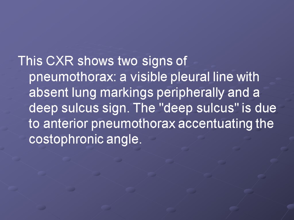 This CXR shows two signs of pneumothorax: a visible pleural line with absent lung